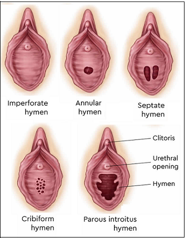 Different Types of Hymen