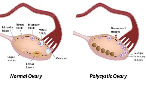  Ovary with PCOS